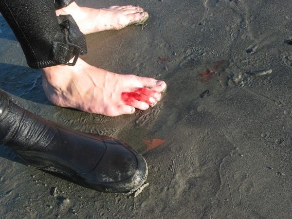 Fig. 3 - injured foot related to a stingray