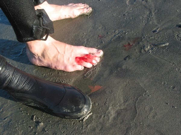 16.jpg Fig. 3 - injured foot related to a stingray