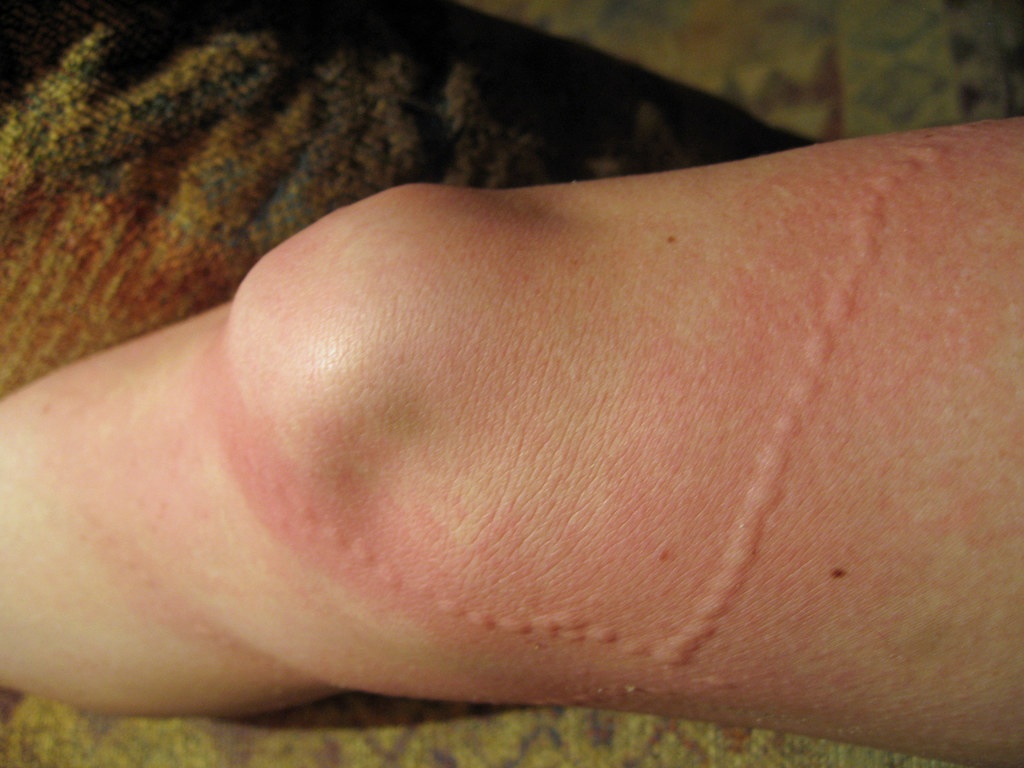 seajelly-sting.jpg scar from sea jelly sting