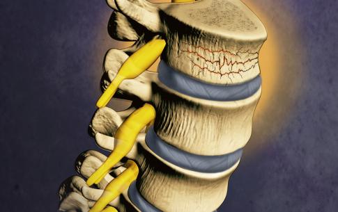 Jim Dowdalls Sample Work - Spinal Compression Fracture