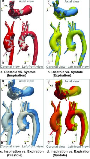 motion of unrepaired thoraic aorta from Suh lab